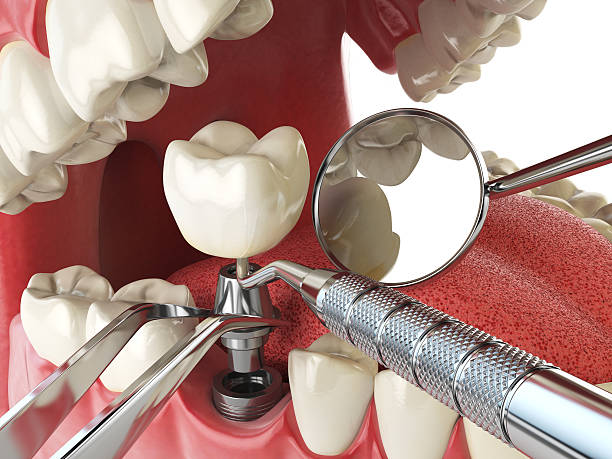 Best Emergency Tooth Extraction in Craigsville, WV