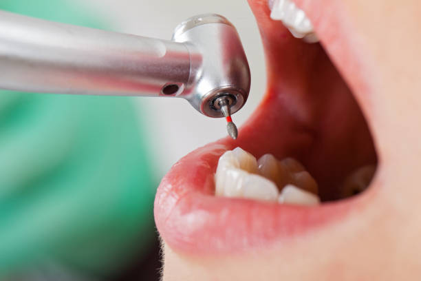 Best Emergency Broken Tooth Repair in Craigsville, WV